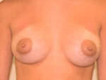 Patient # 83252 After Photo # 2