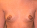 Patient # 83252 Before Photo # 1