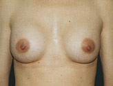 Patient # 32340 After Photo # 2