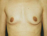 Patient # 32340 Before Photo # 1