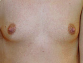 Patient # 59381 Before Photo # 1