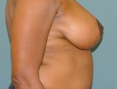 Patient # 54156 After Photo # 4