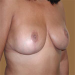 Patient # 87892 After Photo # 4