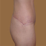 Patient # 54387 After Photo # 4