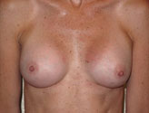 Patient # 29625 After Photo # 2