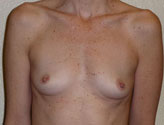 Patient # 29625 Before Photo # 1