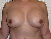 Patient # 67364 After Photo # 2