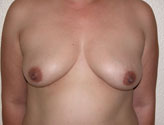 Patient # 67364 Before Photo # 1