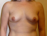 Patient # 31221 Before Photo # 1