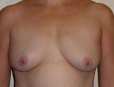 Patient # 43351 Before Photo # 1