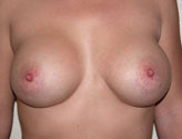 Patient # 73725 After Photo # 2