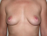 Patient # 73725 Before Photo # 1