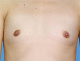 Patient # 34341 Before Photo # 1