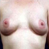 Patient # 15413 Before Photo # 1