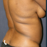 Patient # 10767 After Photo # 2