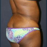 Patient # 10767 After Photo # 4