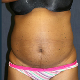 Patient # 10767 Before Photo # 1