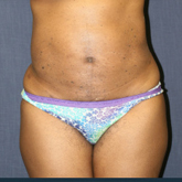 Patient # 10767 Before Photo # 3