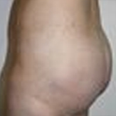 Patient # 63214 After Photo # 4