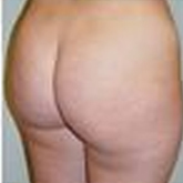 Patient # 63214 Before Photo # 1
