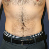 Patient # 72745 After Photo # 2