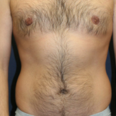 Patient # 72745 Before Photo # 1