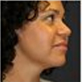 Patient # 63126 After Photo # 4