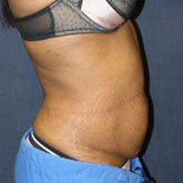 Patient # 70635 Before Photo # 1