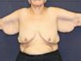 Patient # 60587 Before Photo # 3