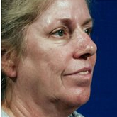 Patient # 34348 Before Photo # 3