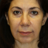 Patient # 28683 After Photo # 2