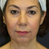 Patient # 28683 Before Photo # 1