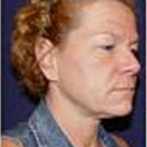 Patient # 25965 Before Photo # 3
