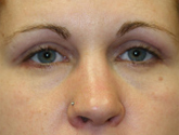 Patient # 70070 After Photo # 2