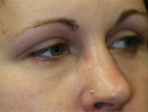 Patient # 70070 After Photo # 4