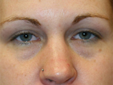 Patient # 70070 Before Photo # 1