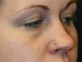 Patient # 70070 Before Photo # 3
