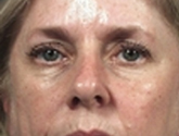 Patient # 27557 Before Photo # 1
