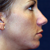 Patient # 28570 After Photo # 2