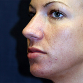 Patient # 28570 After Photo # 4