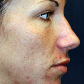 Patient # 28570 Before Photo # 1