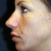 Patient # 28570 Before Photo # 3