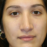 Patient # 16451 After Photo # 2