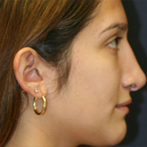 Patient # 16451 After Photo # 4