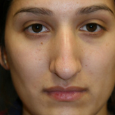Patient # 16451 Before Photo # 1