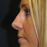 Patient # 32272 After Photo # 2