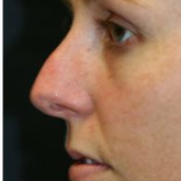 Patient # 32272 Before Photo # 1
