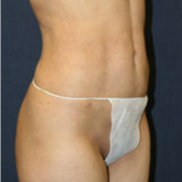 Patient # 92789 After Photo # 2