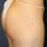 Patient # 92789 After Photo # 4