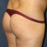Patient # 92789 Before Photo # 3